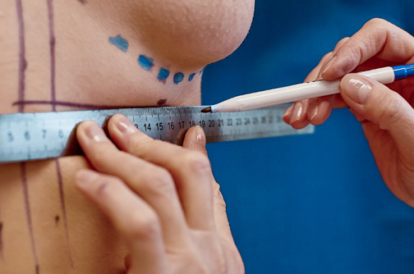 Schermata 2020-11-13 alle 18.55.43 Mastopessi con fili elastici